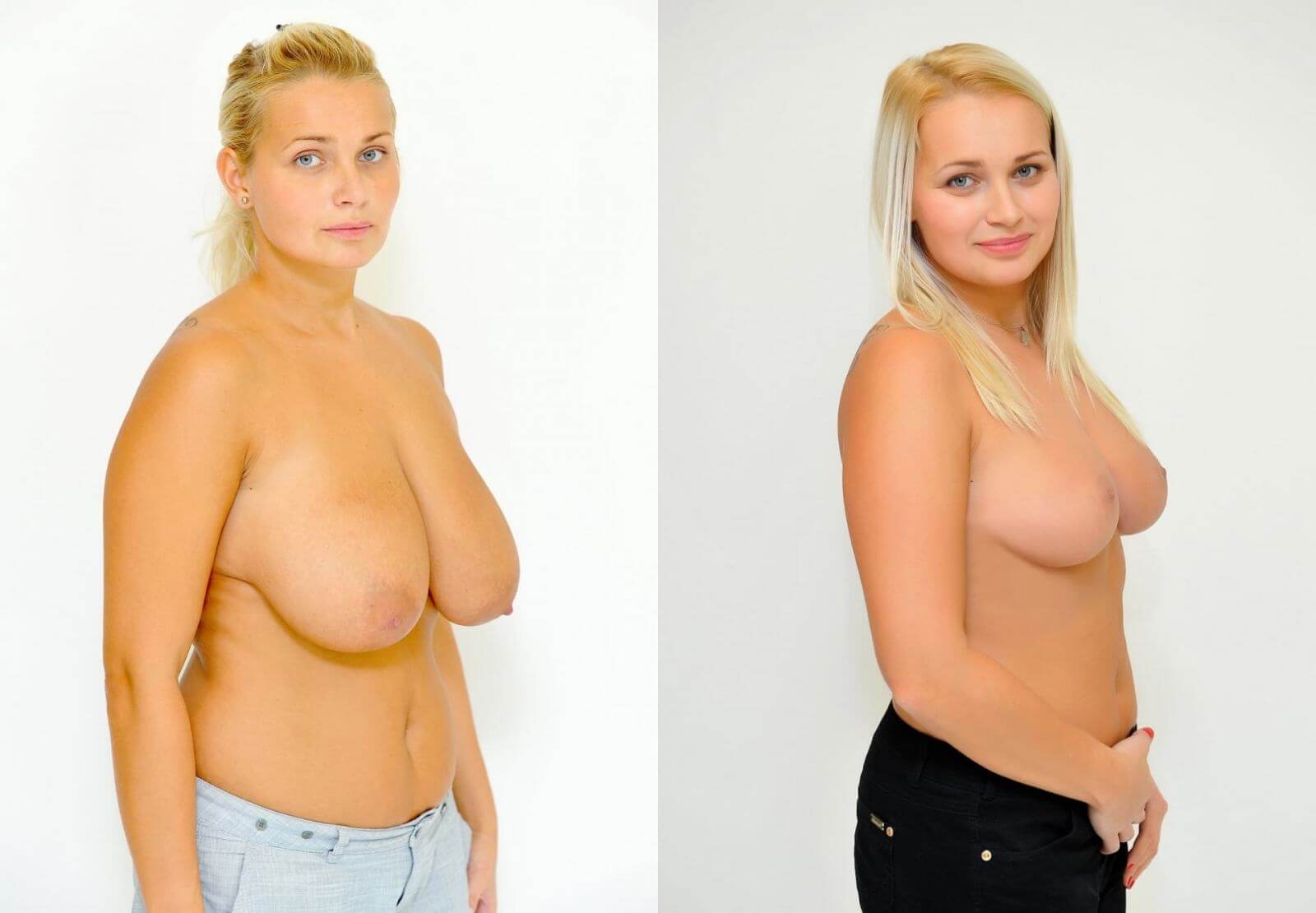 Большая грудь с&nbsp;высокой степенью птоза всегда портит осанку, что и&nbsp;приводит болевым ощущениям