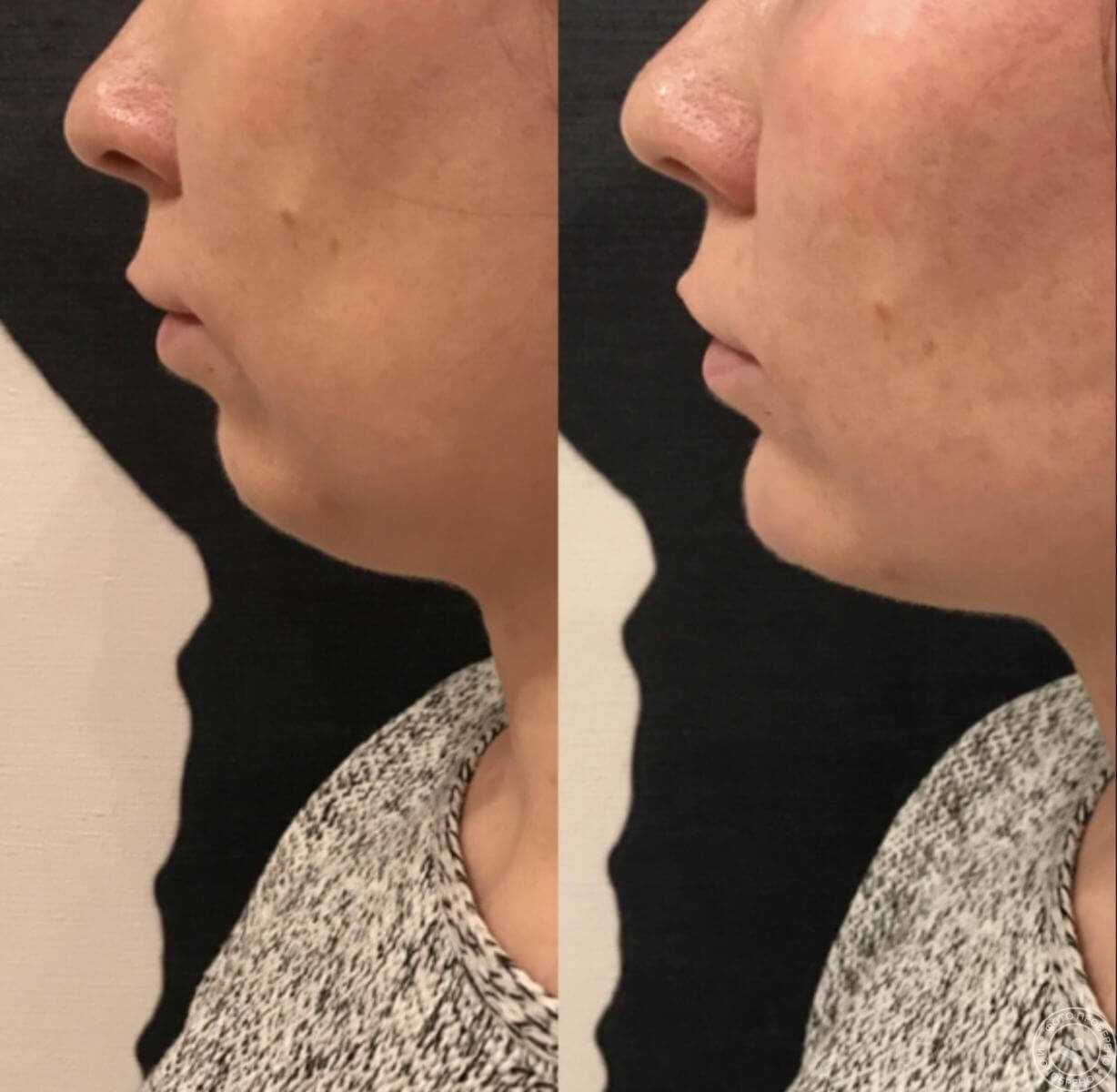 Исправление подбородка филлерами – до и после