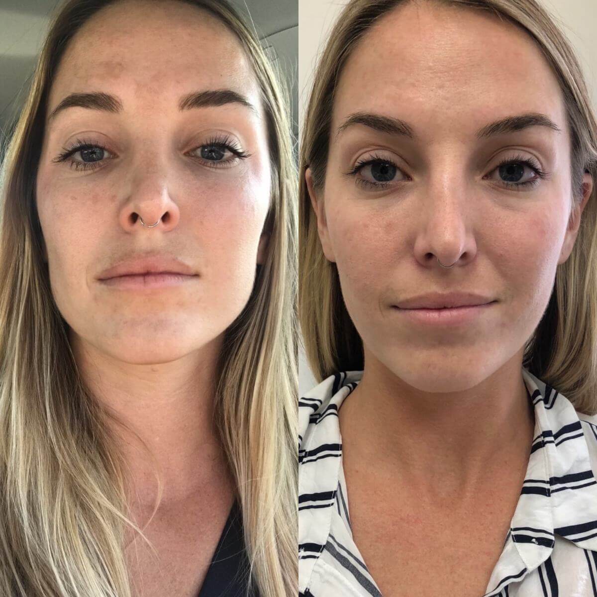 Инъекции ботокса позволяют обрести очерченный подбородок и V-образную форму лица