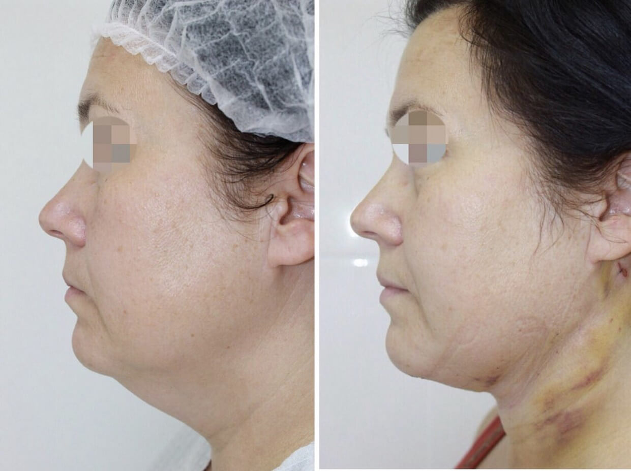 Липосакция шеи удаляет второй подбородок навсегда, если следить за весом