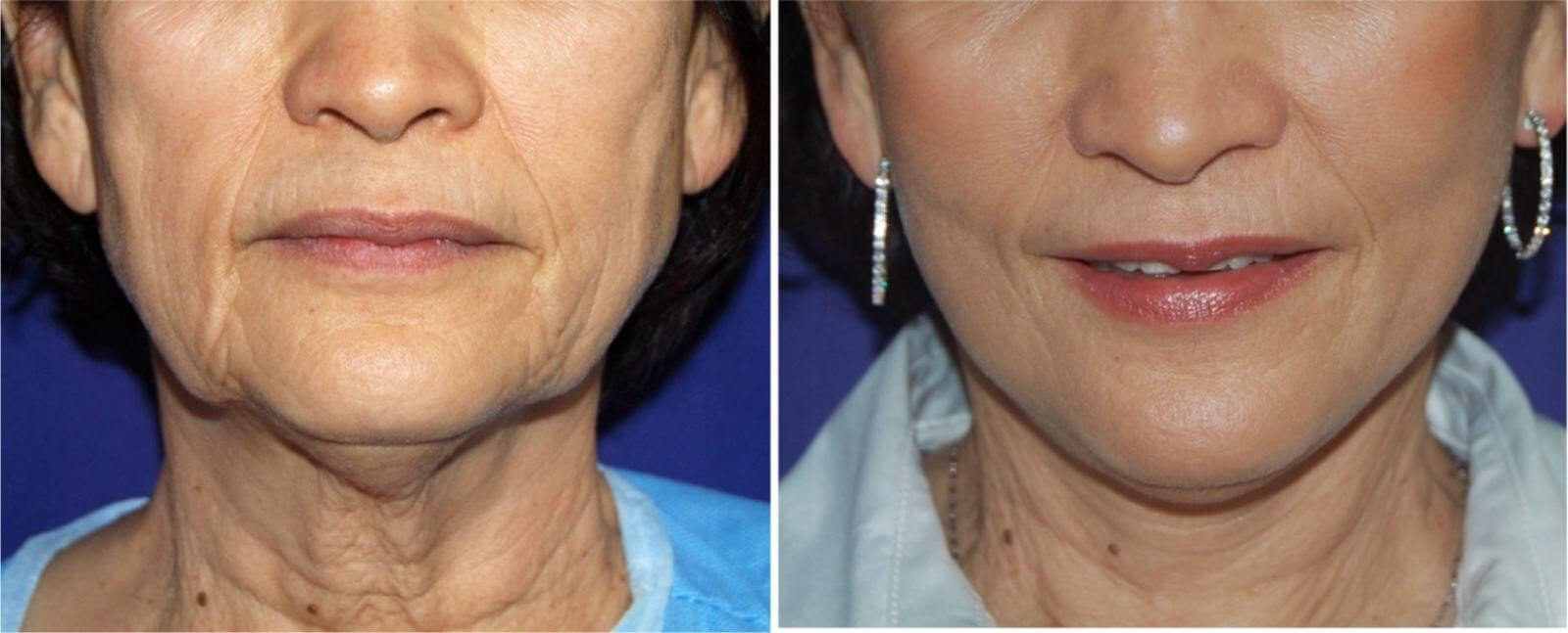 Подтяжка шеи – результаты до и после