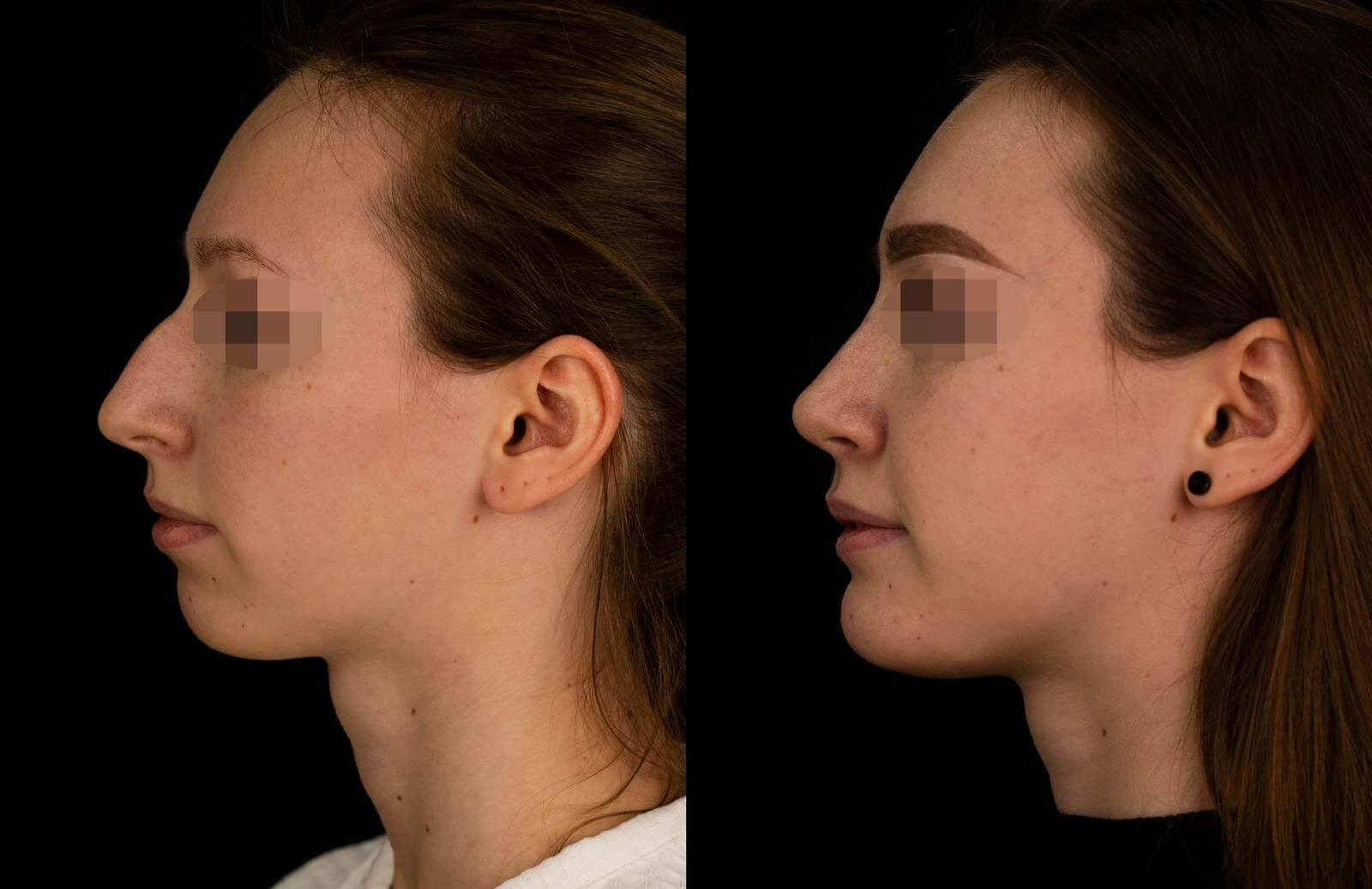 Ментопластика – операция сложная, но эффективная при самых серьезных дефектах подбородка