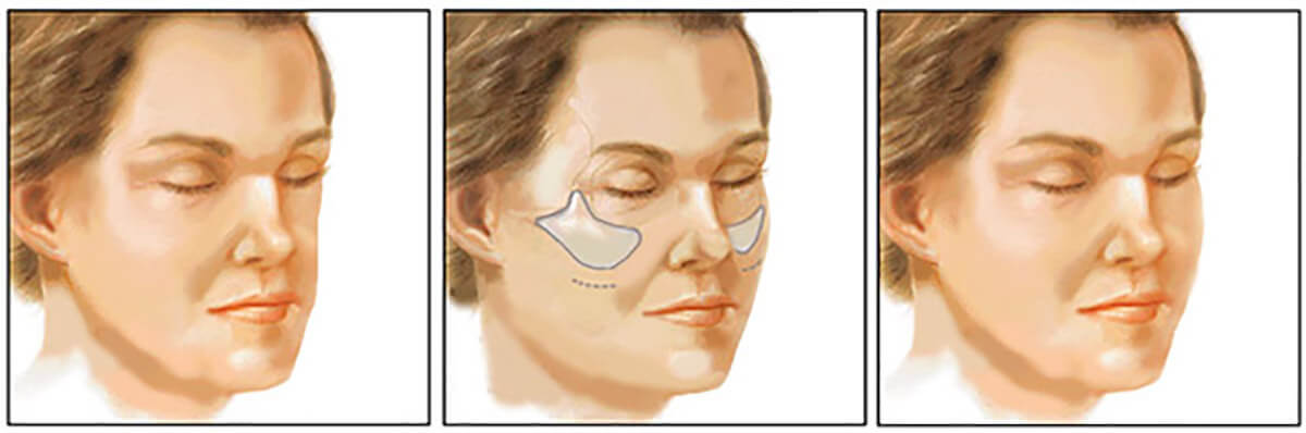 Установка силиконовых имплантов в&nbsp;скулы