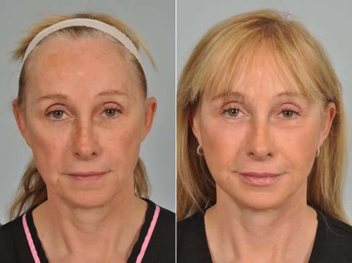 Липофилинг лица &ndash; до&nbsp;и&nbsp;после