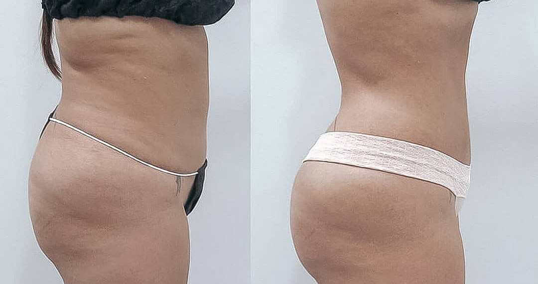 Липофилинг ягодиц: жир с боков и живота добавляет объем там, где он нужен