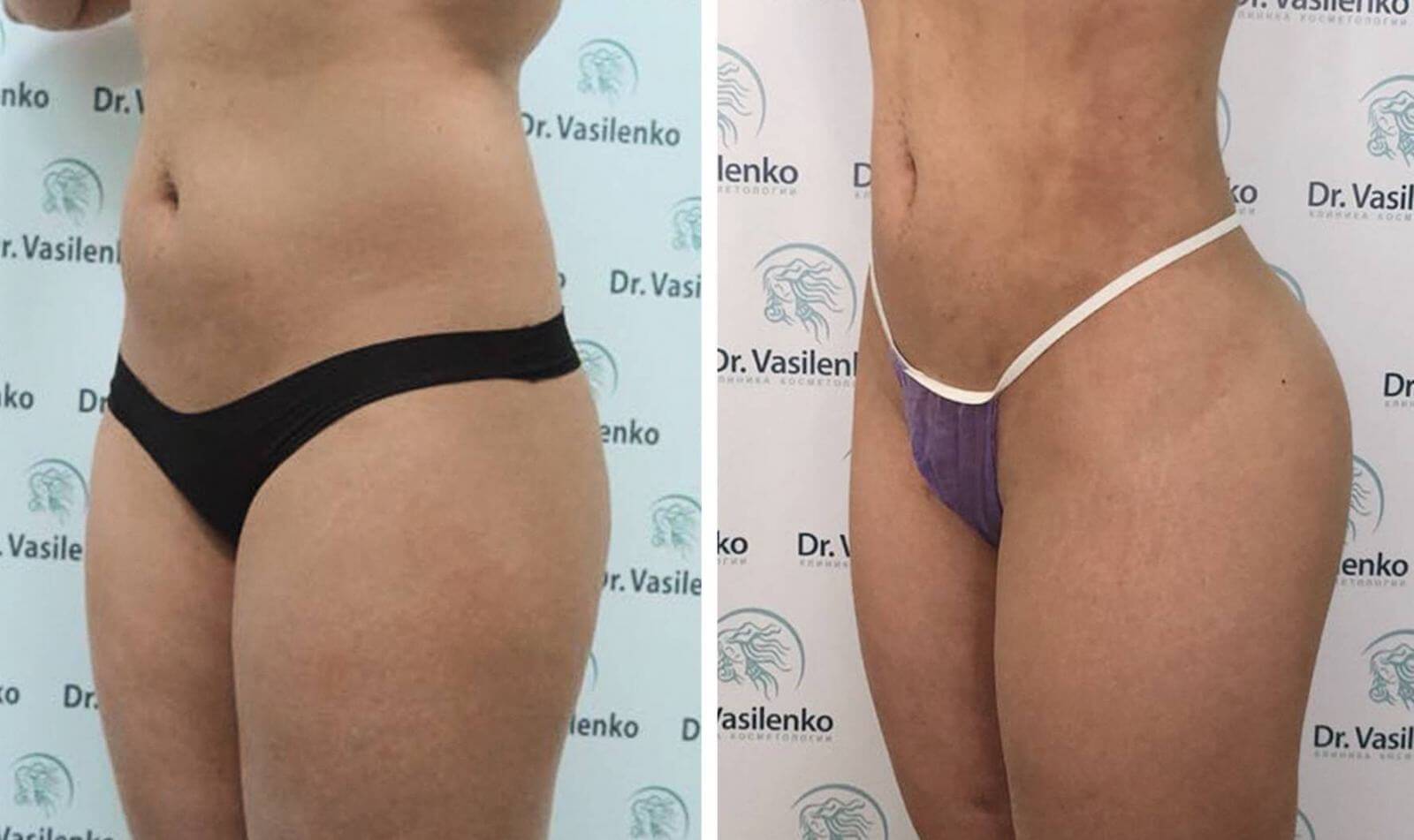 Эффект от липофилинга особенно выразительный за счет постройневшего живота