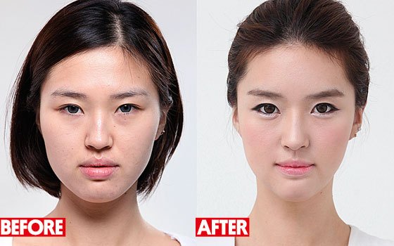 Фото до&nbsp;после коррекции овала лица до&nbsp;35 лет