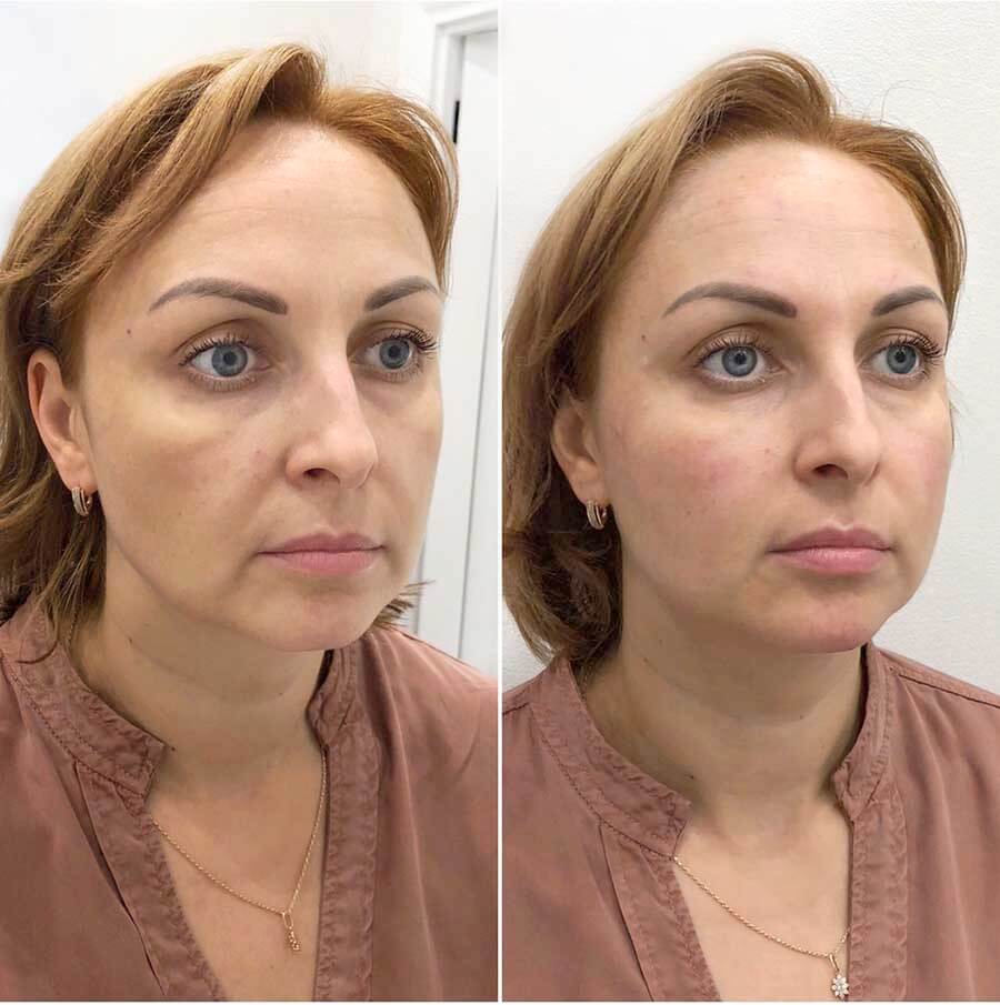 Пластическая операция &ndash; подтяжка овала лица