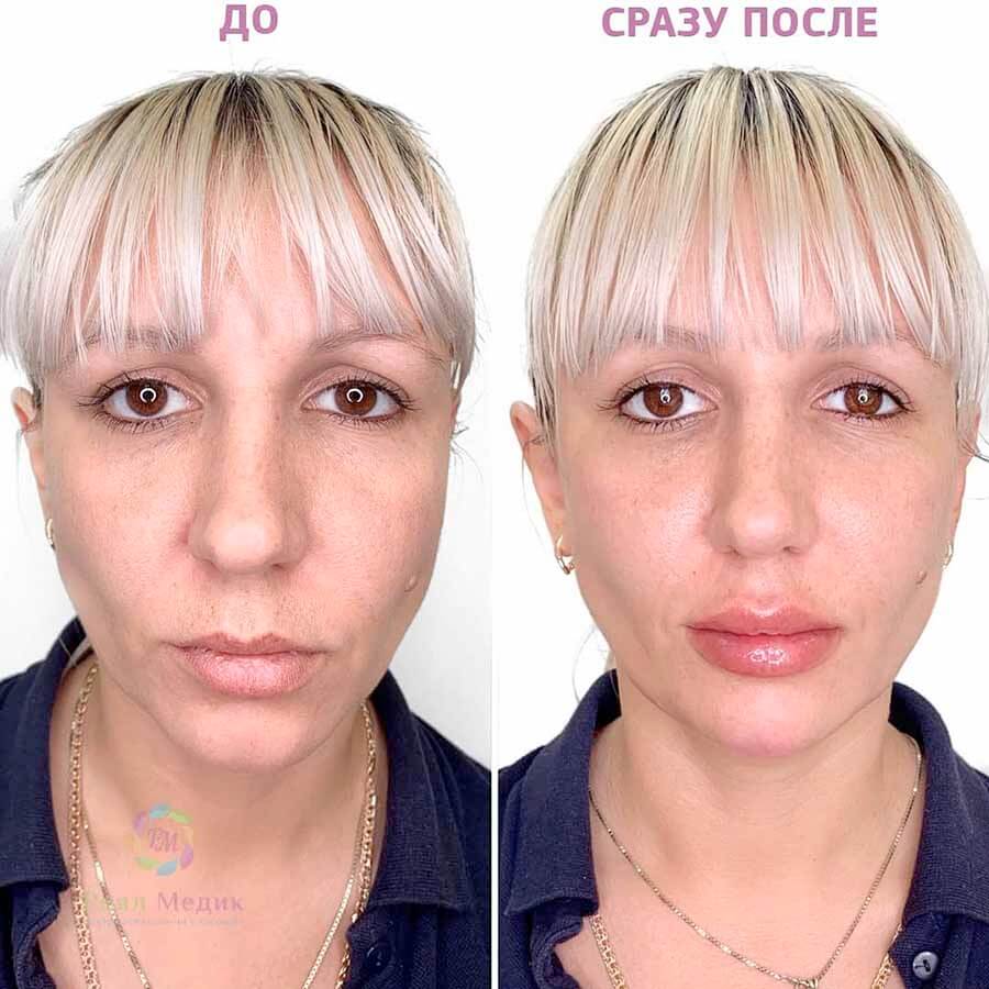 Коррекция овала лица с&nbsp;использованием косметологии