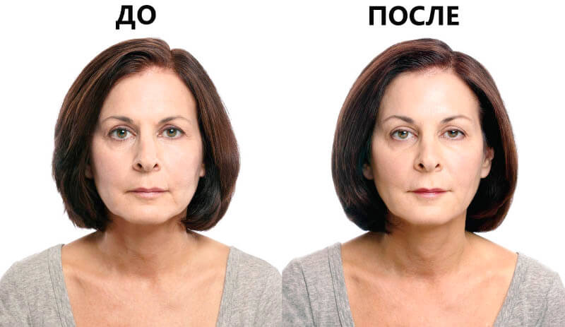 Фото до&nbsp;после армирования лица нитями