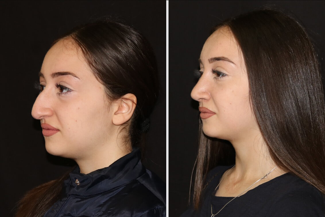 Ринопластика кардинально меняет внешность и&nbsp;дает бонусы в&nbsp;плане карьеры