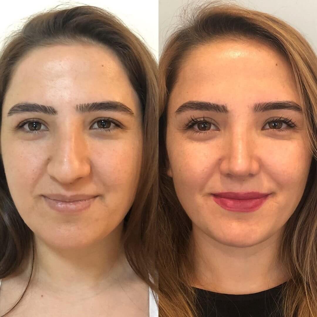 До &ndash; картошка, после &ndash; изящный тонкий носик