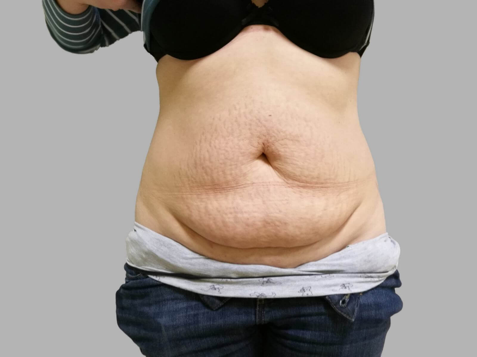 Если вы хотите подтянуть живот, пластику ягодиц придется сделать в&nbsp;следующий раз