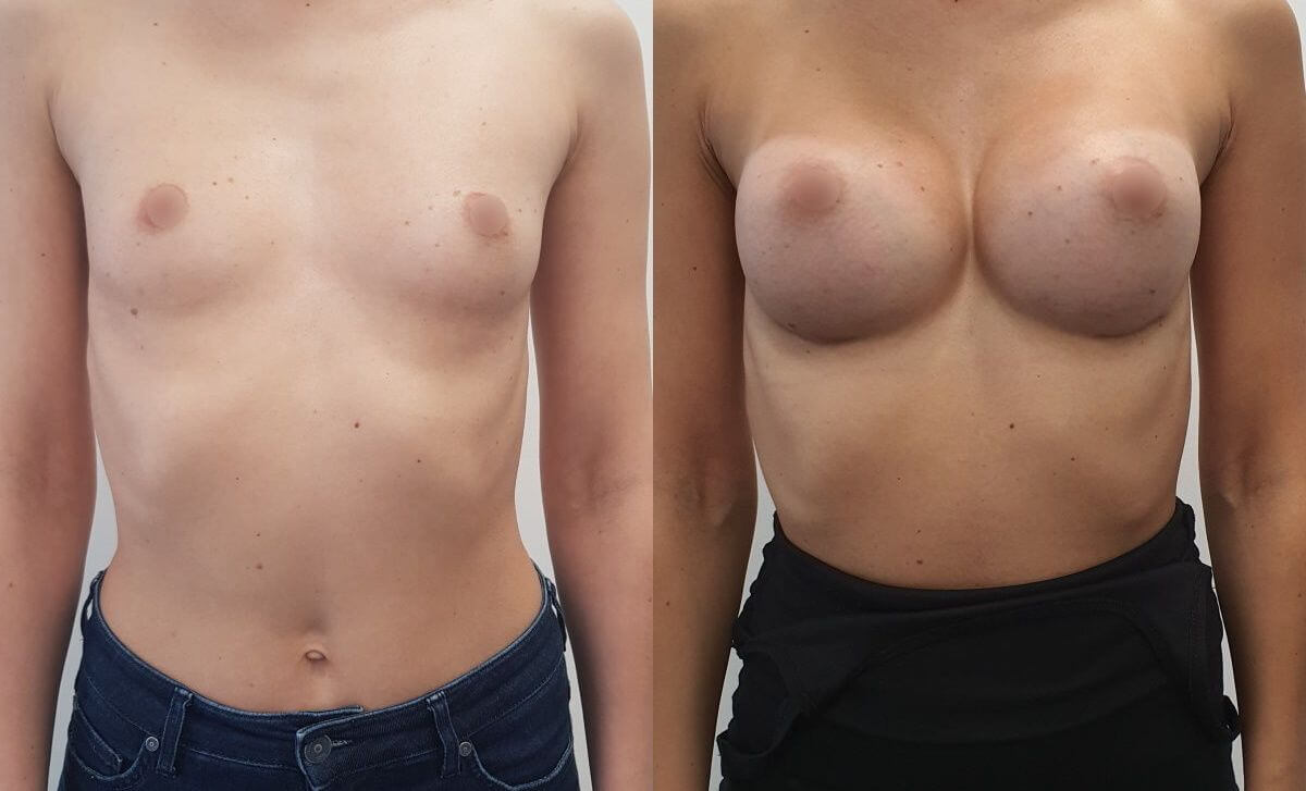 Импланты на&nbsp;худой фигуре могут сильно выделяться и&nbsp;выглядеть неестественно 