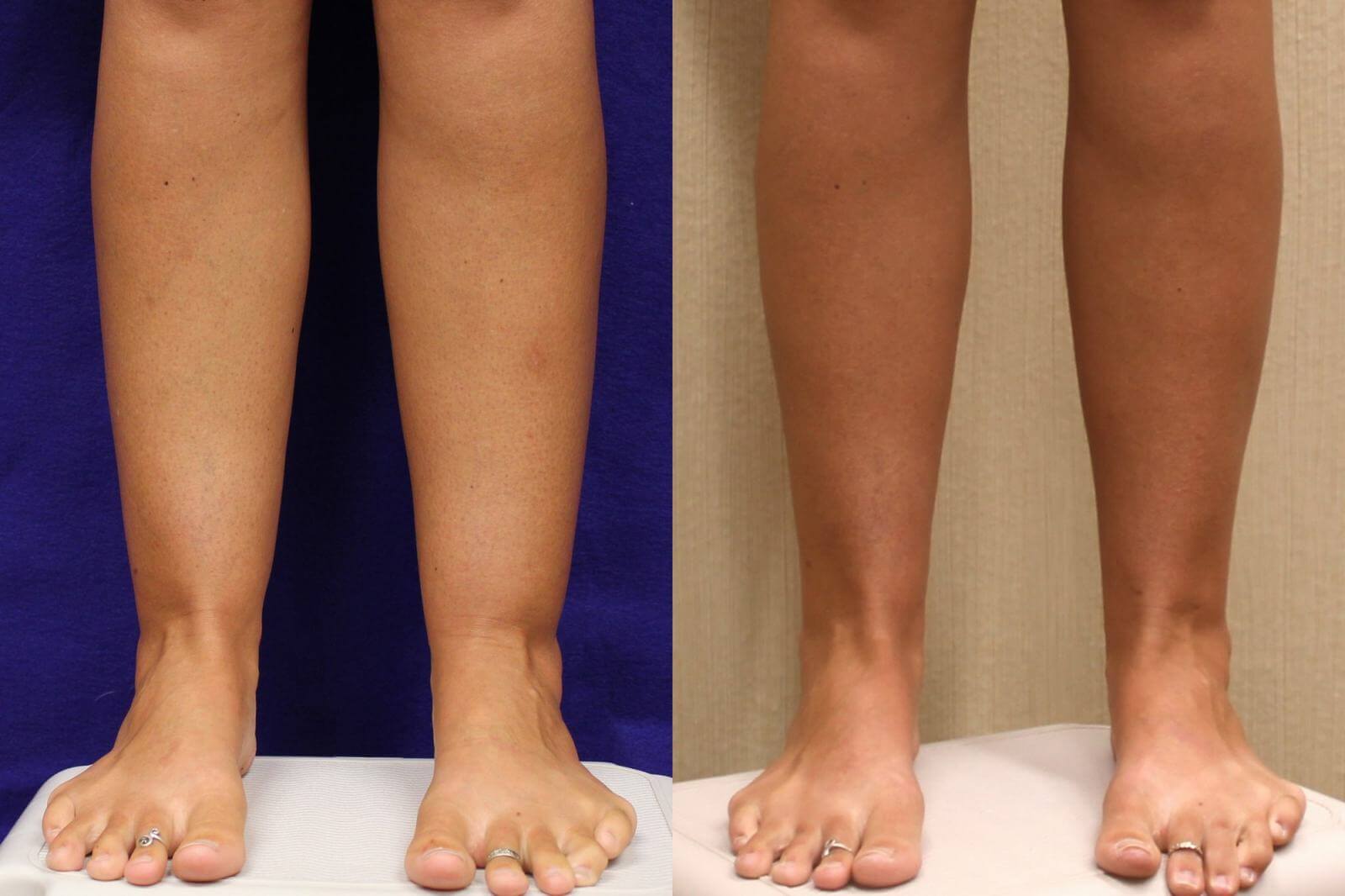 Липосакция лодыжек – фото до и после операции