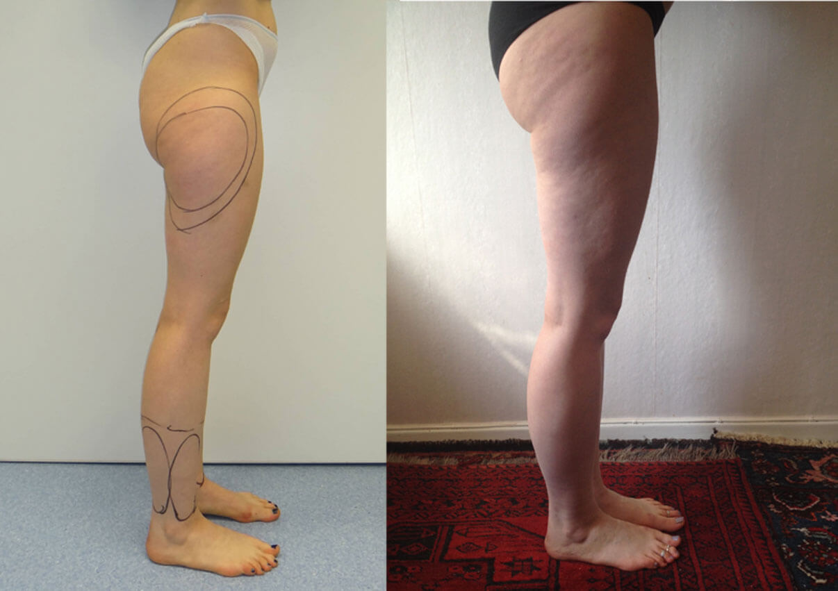 Липосакцию щиколоток нередко сочетают с липосакцией других проблемных зон