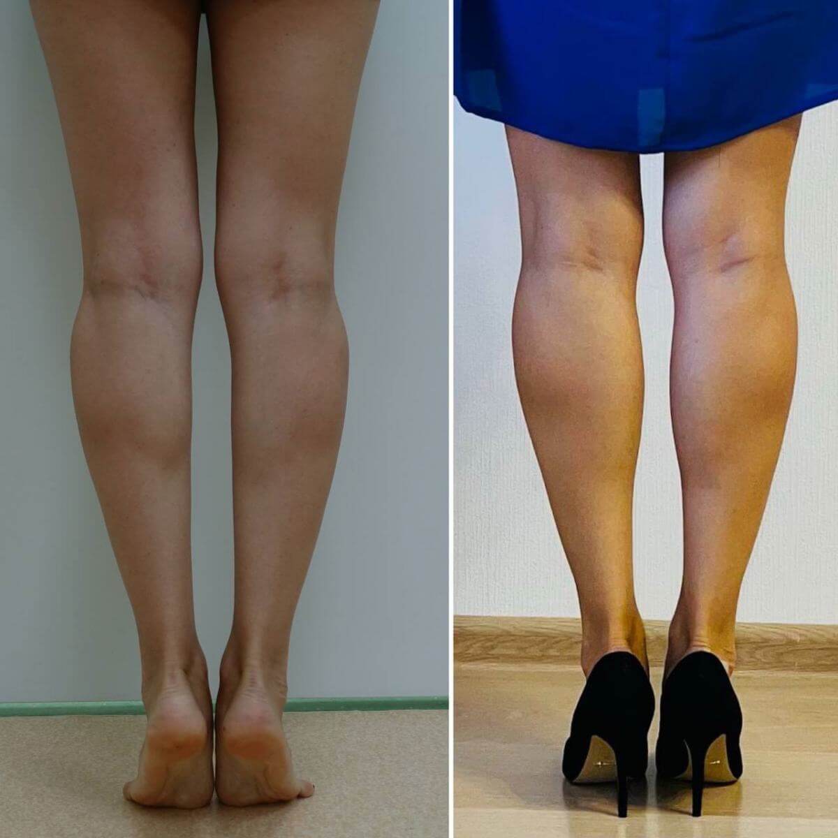Установка имплантов в голени не только исправляет кривизну ног, но и делает лодыжки визуально стройнее и изящнее