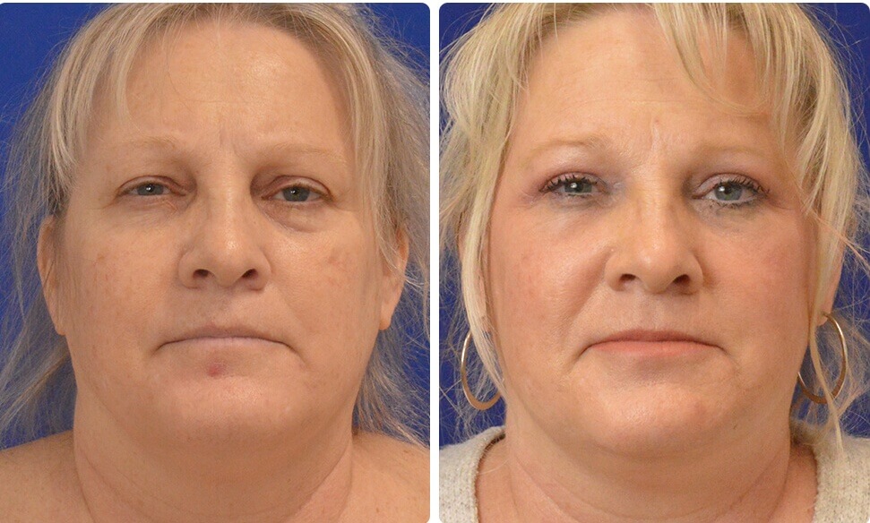 Липофилинг рубцов постакне дает очень естественный результат