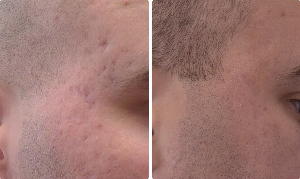 Удаление рубцов постакне с помощью инъекций собственного жира пациента – до и после процедуры