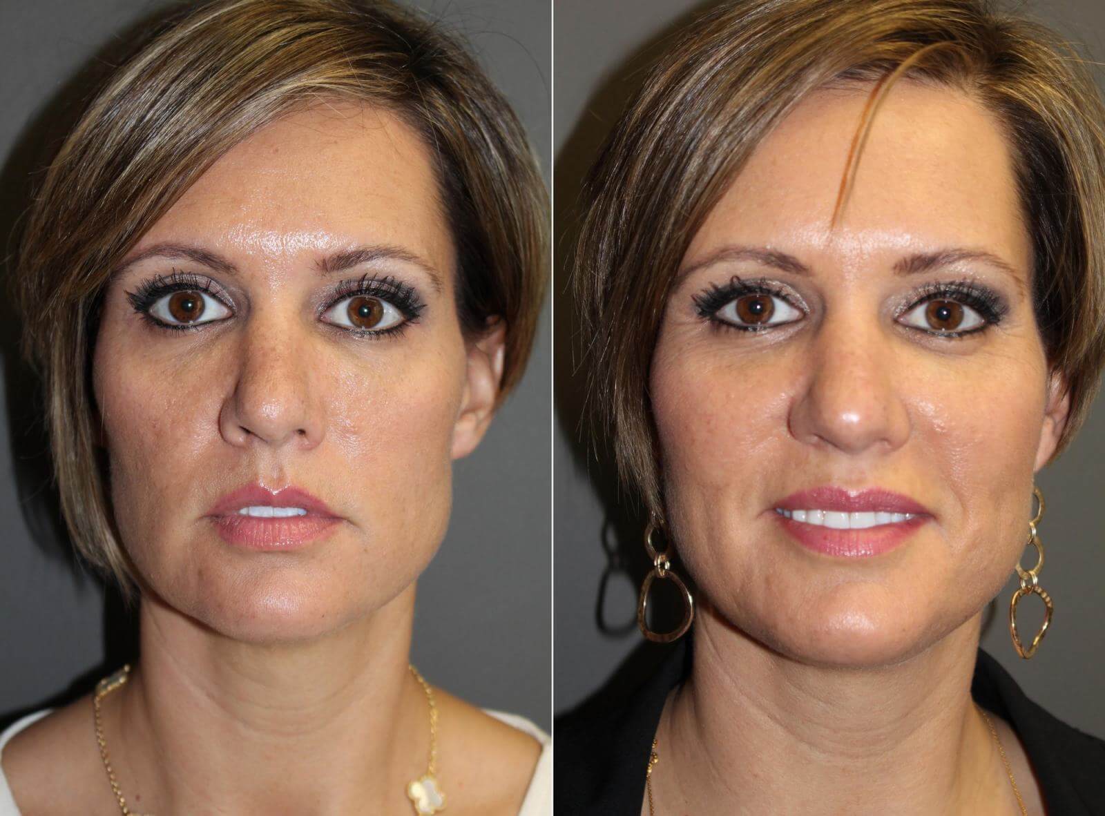 Липофилинг лица: до&nbsp;и&nbsp;после