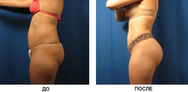 Фото до после липомоделирования