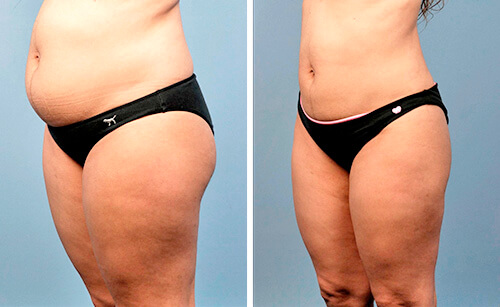 Эффект липоскульптурирования фото до после