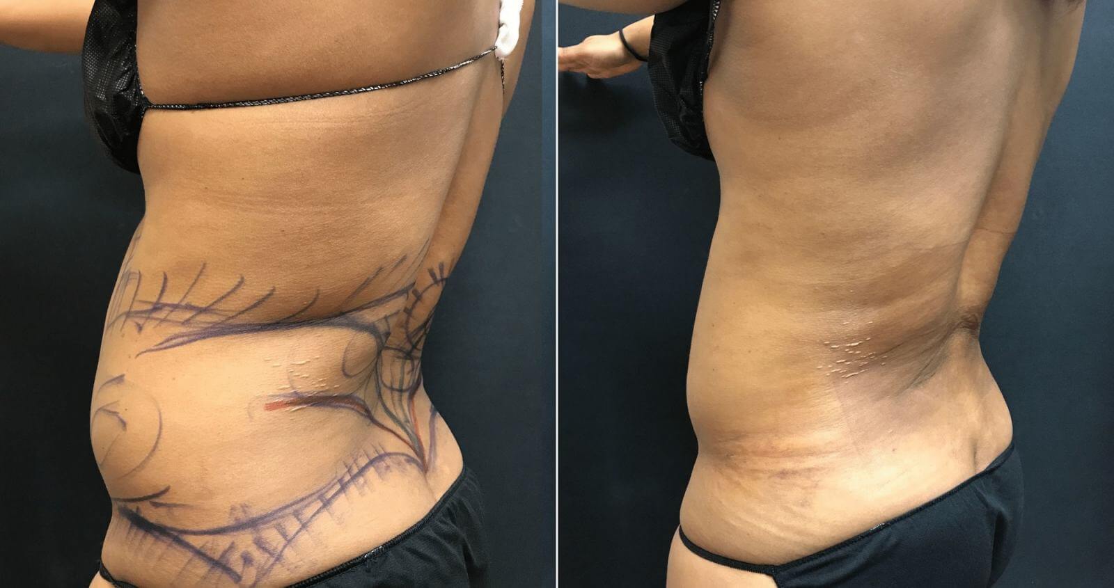 Массаж помогает ускорить восстановление после липосакции живота, боков, спины