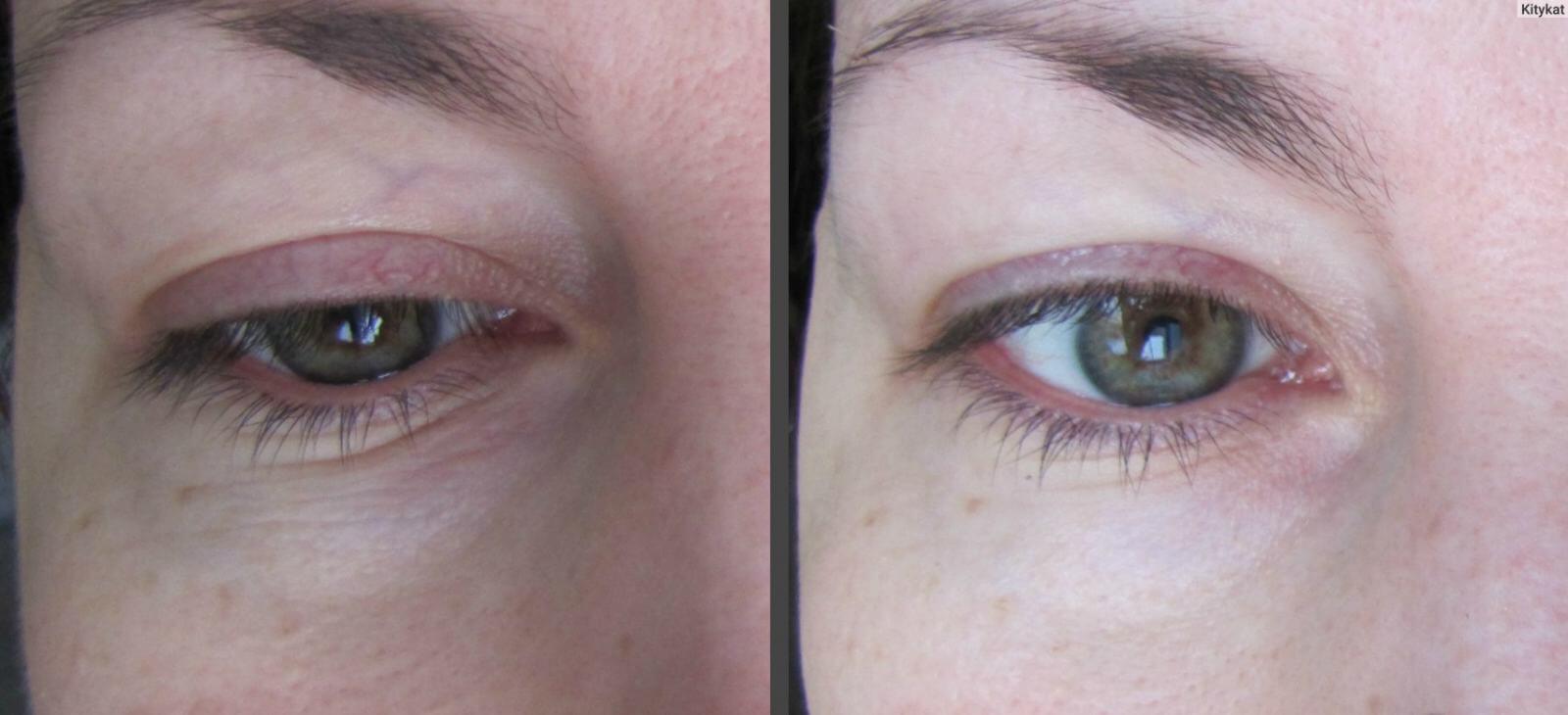 Патчи от&nbsp;мешков под&nbsp;глазами &ndash; эффект есть, но&nbsp;небольшой и&nbsp;временный