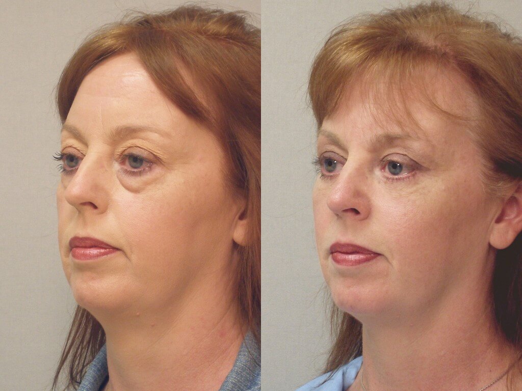 Блефаропластика &ndash; лучший способ борьбы с&nbsp;грыжами и&nbsp;отеками под&nbsp;глазами