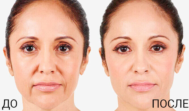 Коррекция носогубных складок фото до&nbsp;после