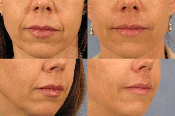 Фото до&nbsp;и&nbsp;после удаления носогубных складок