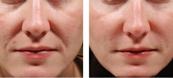 Эффект филлеров фото до&nbsp;после коррекции