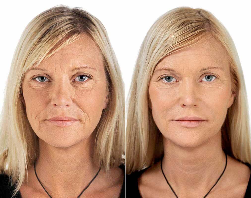 Эффект филлеров фото