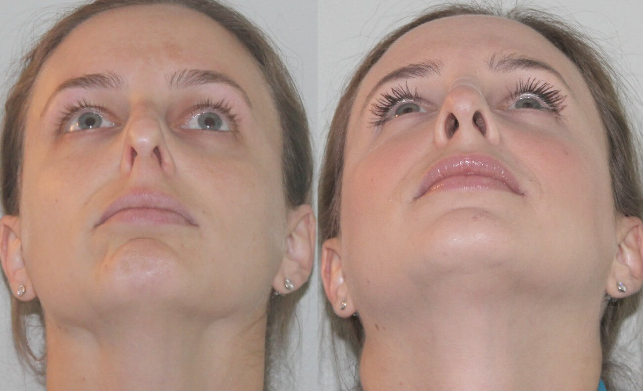 Микроринопластика &ndash; фото до&nbsp;и&nbsp;после
