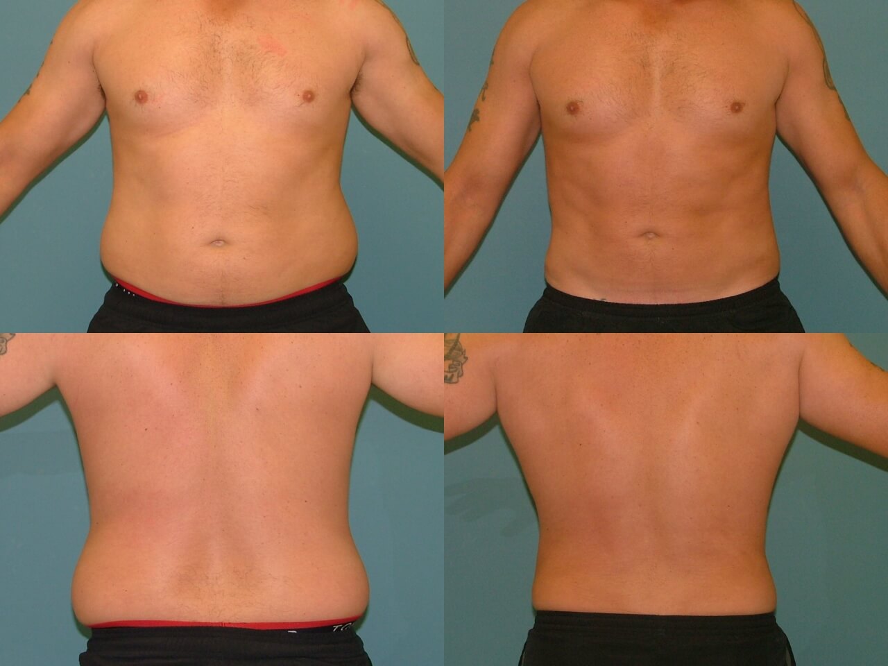 Мужская липосакция дает отличные результаты
