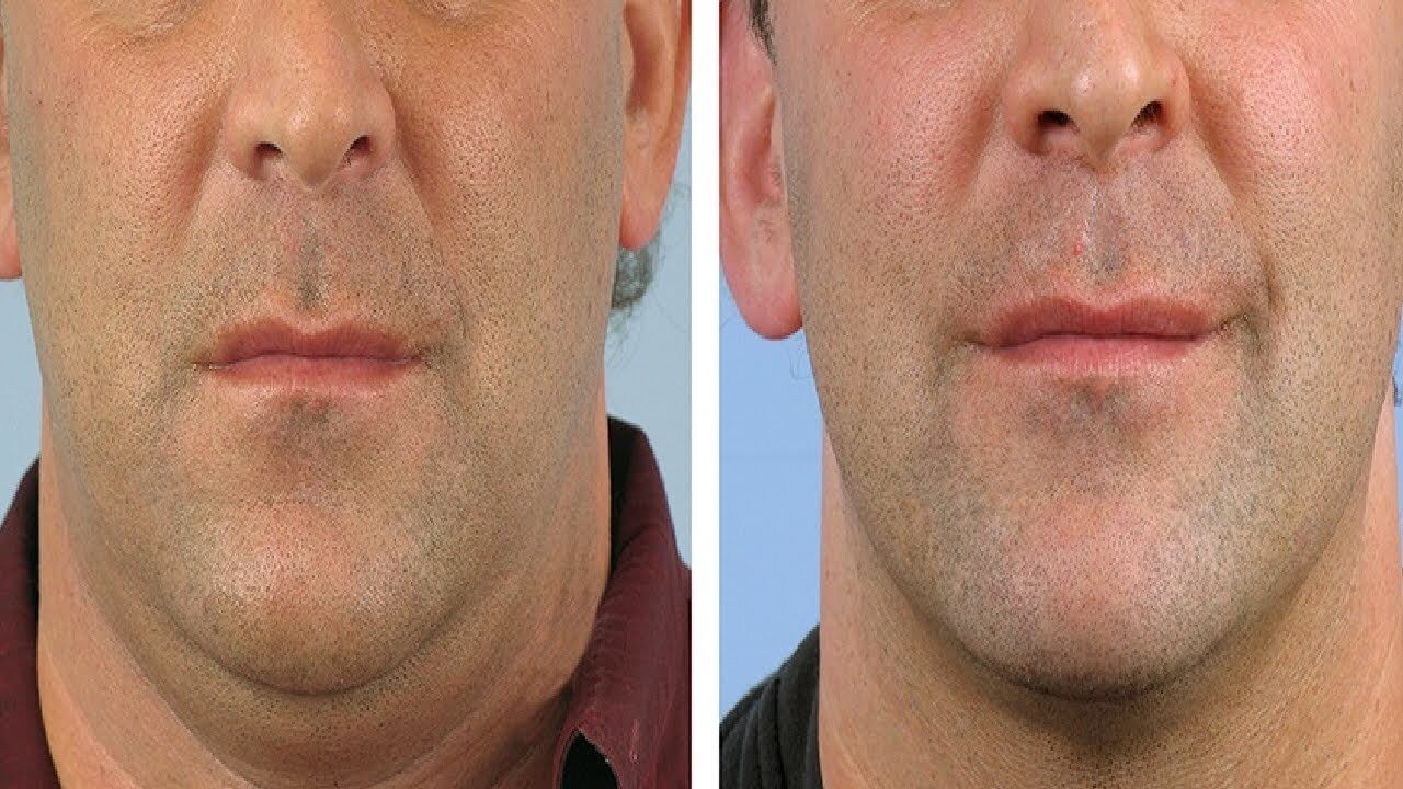 Липосакция подбородка &ndash; популярная операция у&nbsp;мужчин