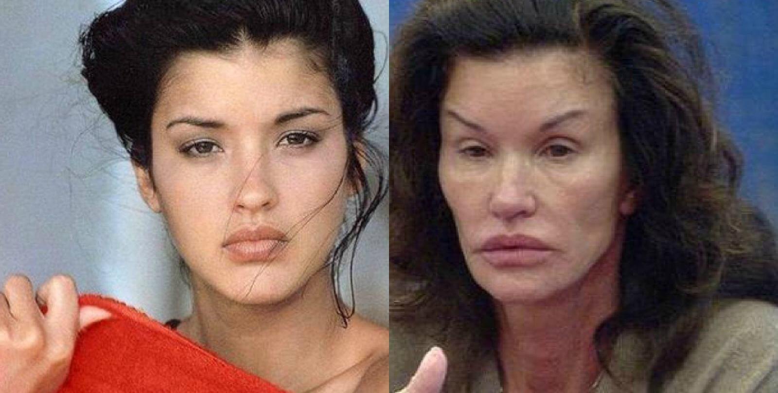 Многие звезды поплатились красотой за&nbsp;удаление комков Биша