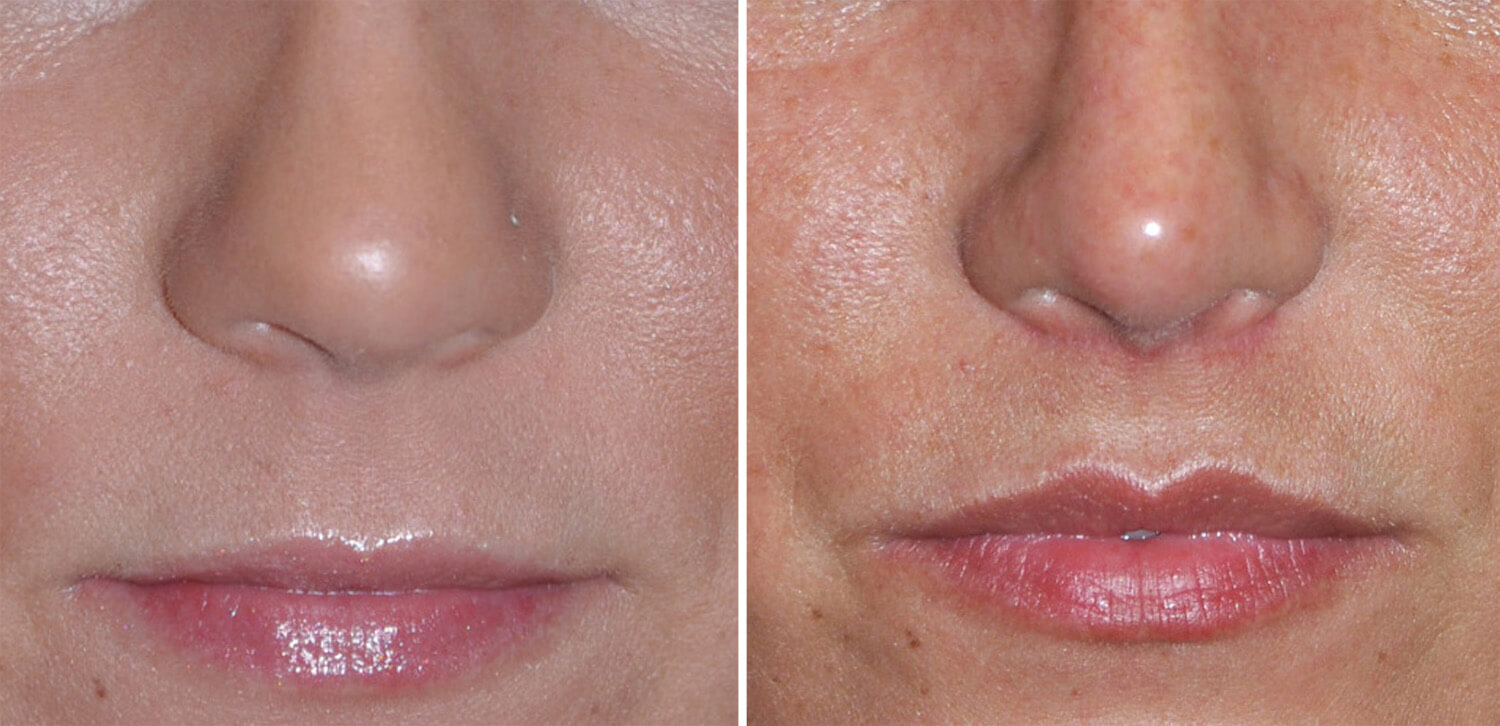 Булхорн &ndash; до&nbsp;и&nbsp;после. Шрам под&nbsp;носом может остаться заметным навсегда