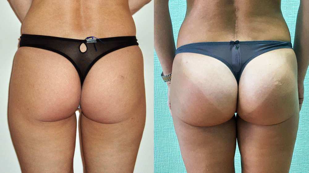 Глютеопластика стремительно ворвалась в ТОП-3 популярных эстетических операций