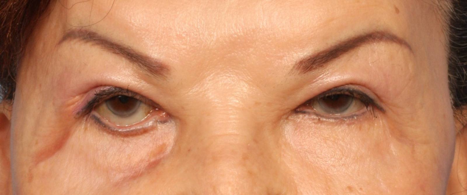  Результаты неудачной блефаропластики могут выглядеть устрашающе