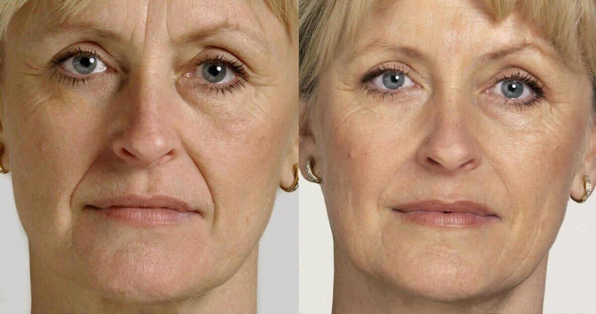 Фото до и после блефаропластики: небольшая асимметрия