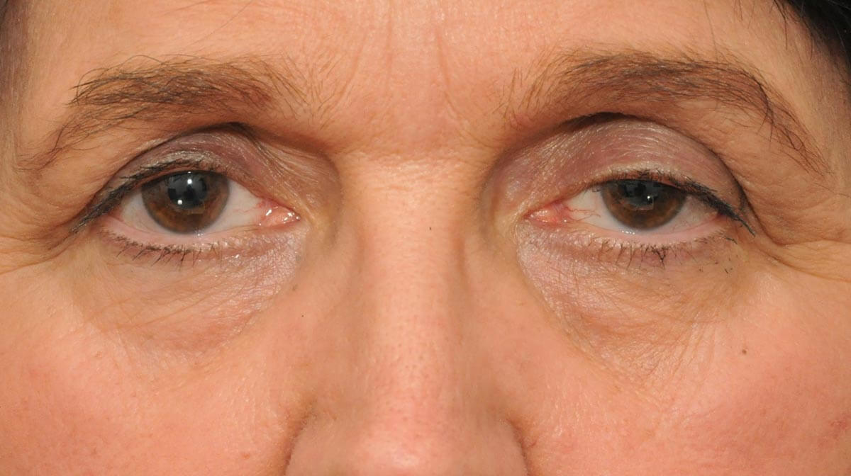 Птоз бровей и век с асимметрией