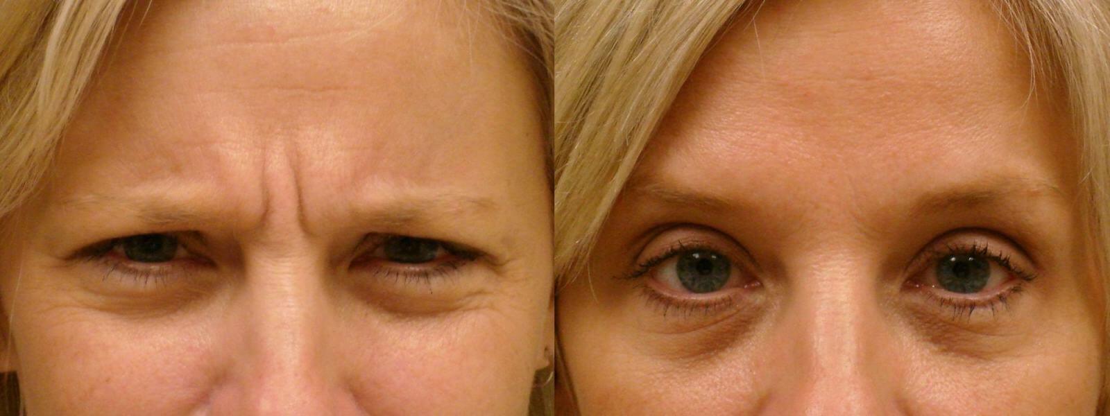 Исправление птоза бровей – до и после операции
