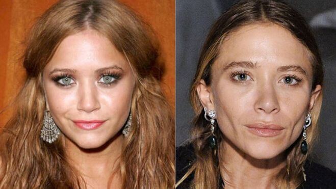 Пример неудачного удаления комков Биша фото Мери-Кейт Олсен