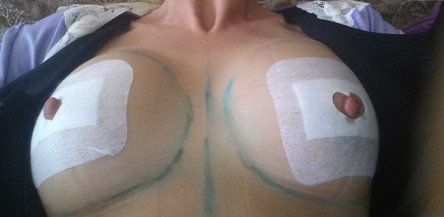 Еще один пример того, как выглядит грудь сразу после установки имплантов