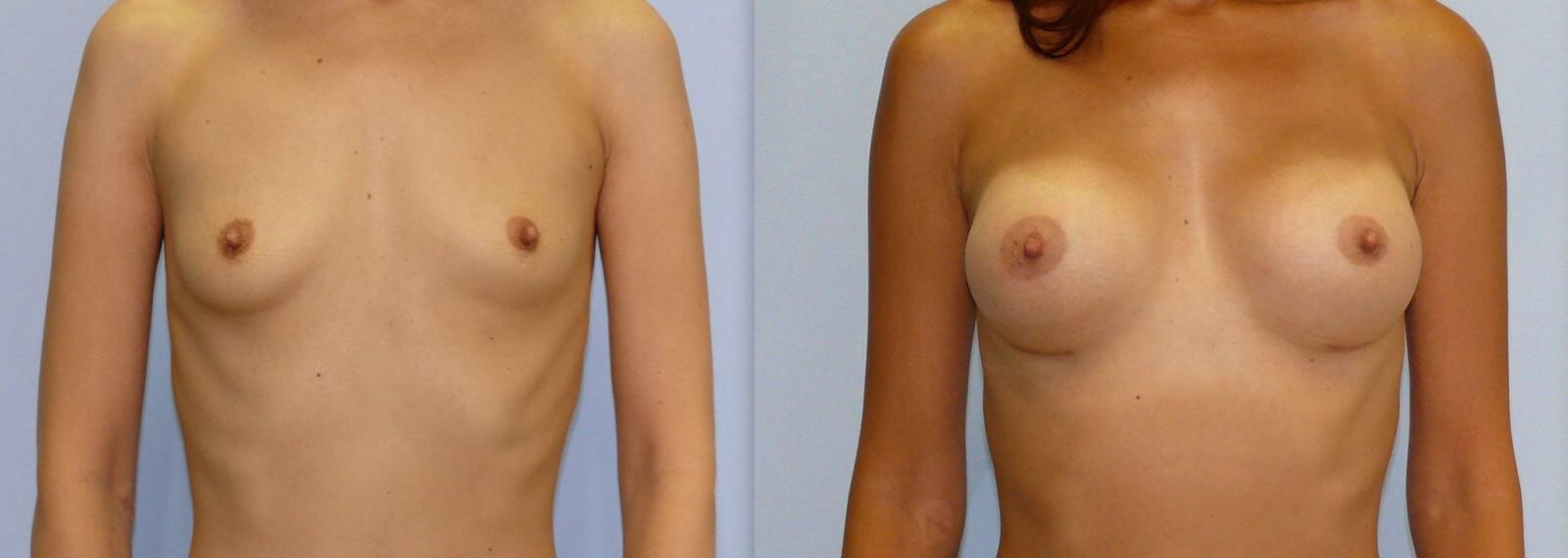 Конечный результат маммопластики стоит того, чтобы подождать опущения имплантов