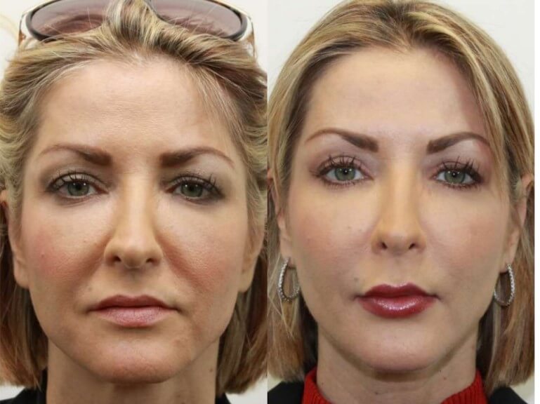 липофилинг лица – фото до после