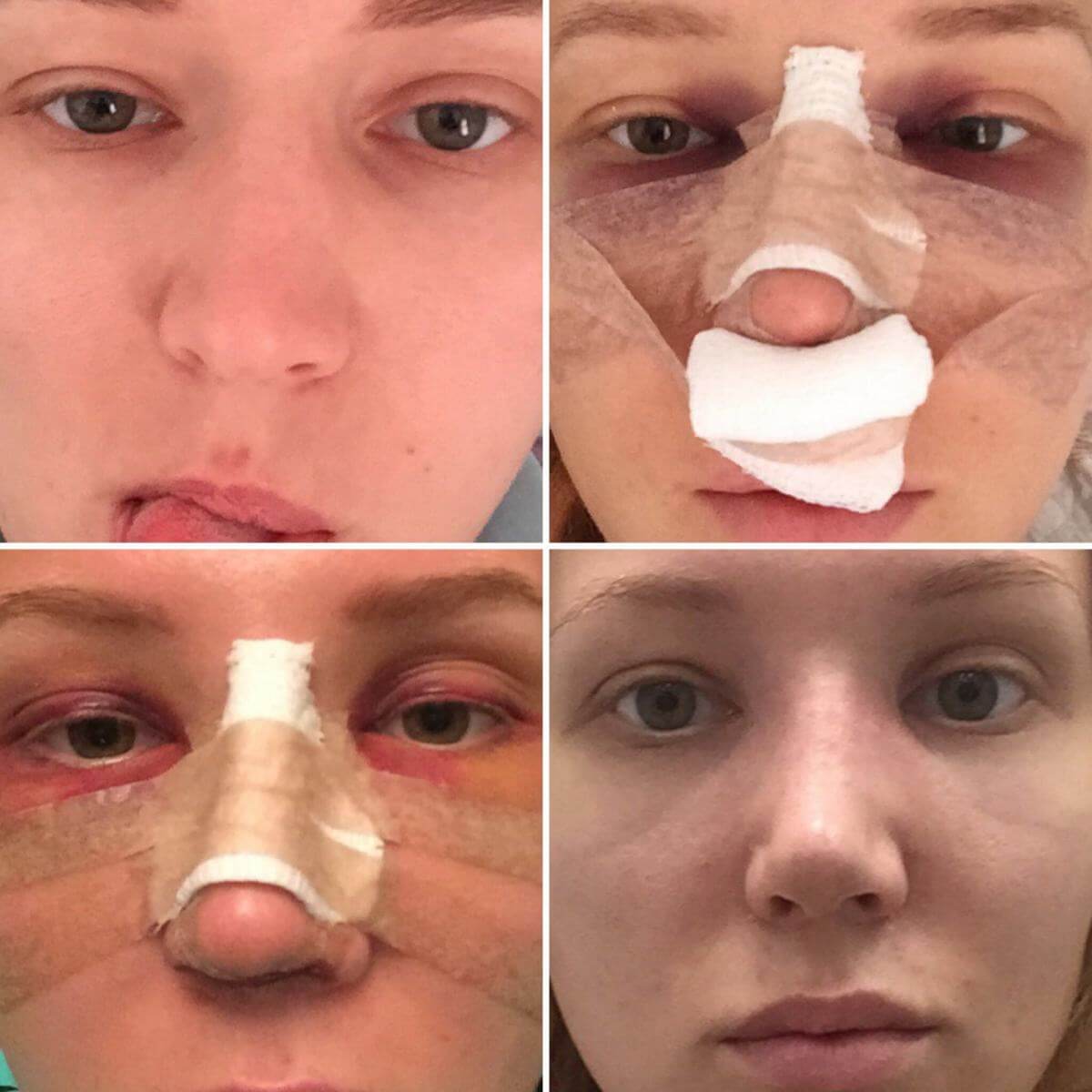 Результаты ринопластики впечатляют, если не&nbsp;портить их вредными привычками