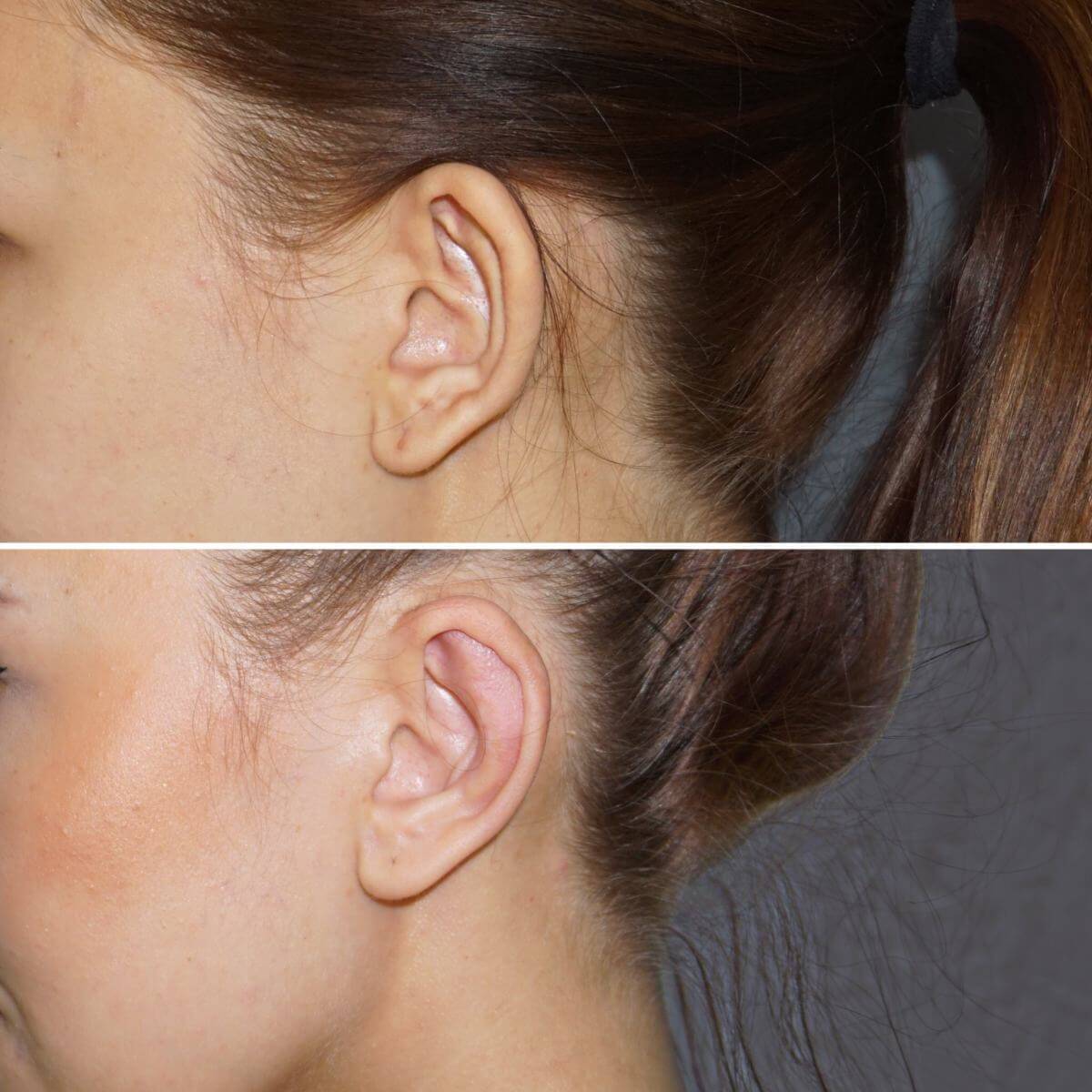 Фото до&nbsp;и&nbsp;после отопластики &ndash; рубцы после швов совершенно незаметны