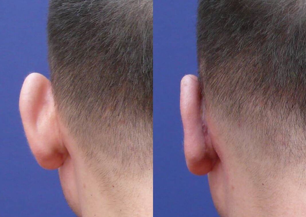 Уже через 7-10 дней швы после отопластики практически не&nbsp;видны